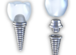 Dental Implants at Rivercrest Family Dental