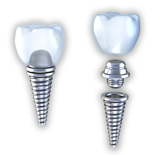 Dental Implants at Rivercrest Family Dental