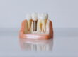 Dental Implants in New Braunfels, TX