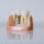 Dental Implants in New Braunfels, TX