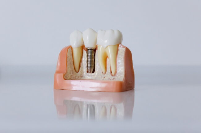 Dental Implants in New Braunfels, TX