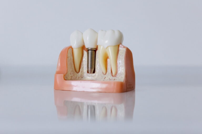 Dental Implants in New Braunfels, TX