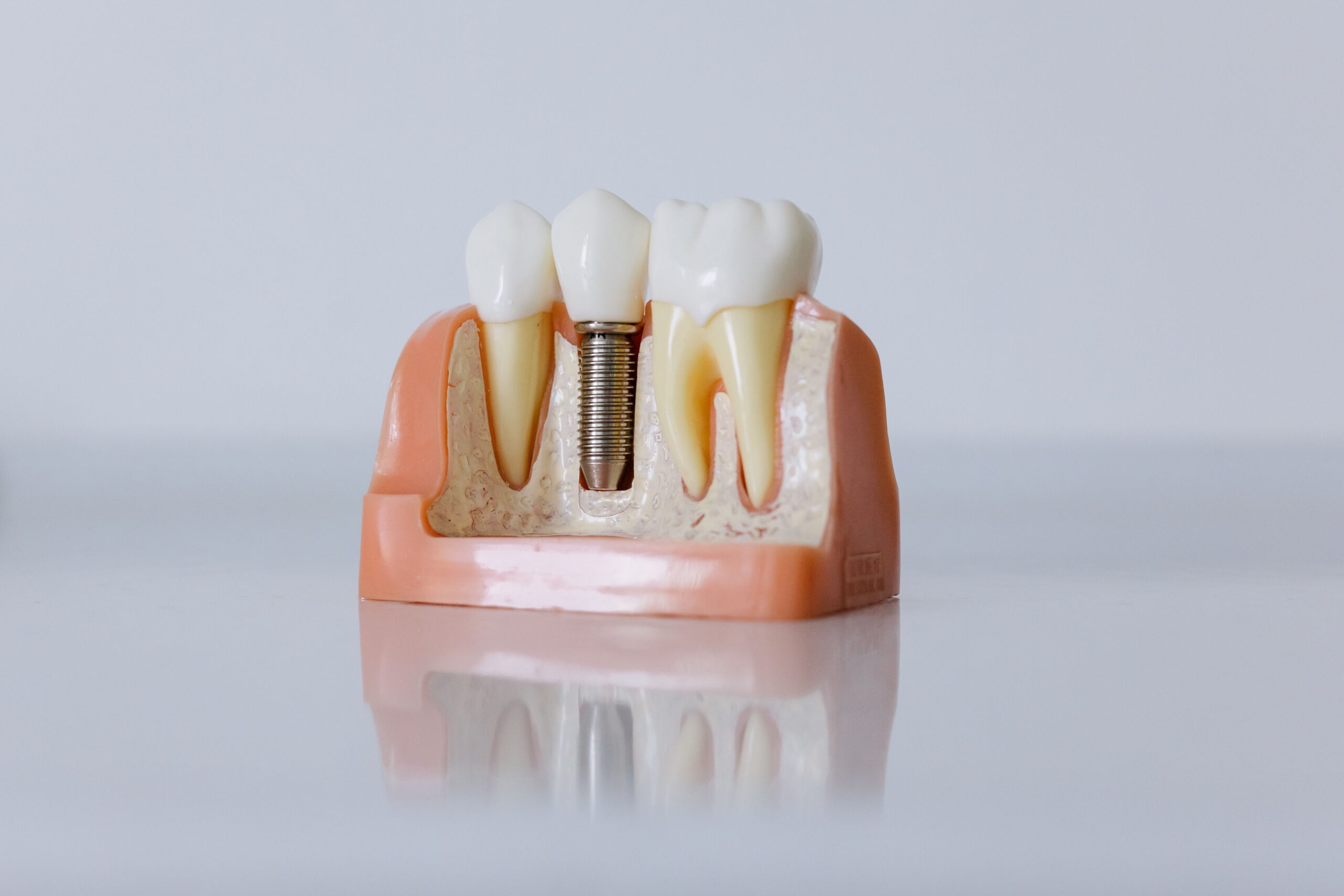 Dental Implants in New Braunfels, TX